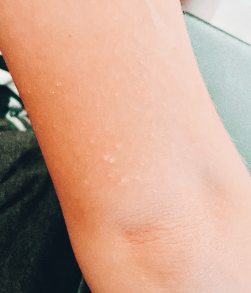 Keratosis Pilaris on Child’s